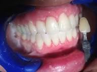 After Dental Procedure - Perfect Smile