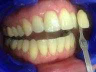 Before Dental Procedure