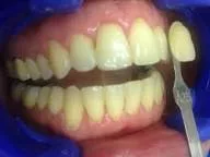 Before Dental Procedure